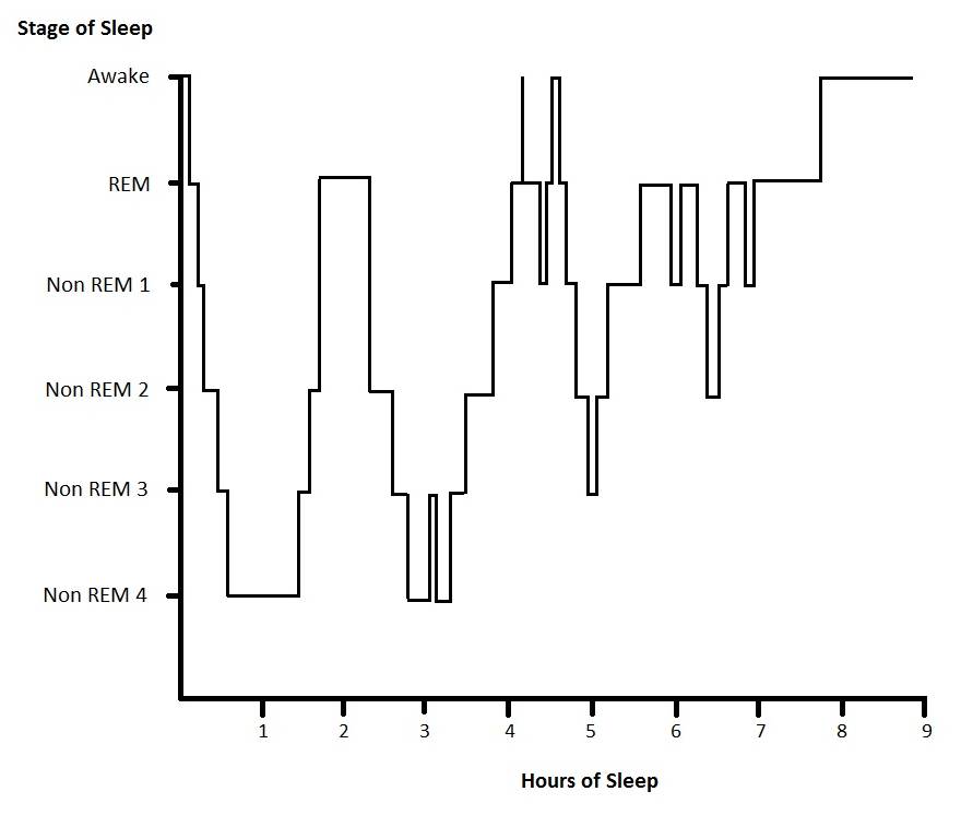 Standard hypnogram showing normal sleep stages over the course of a night